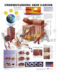 Understanding Skin Cancer Anatomical Chart - Laminated